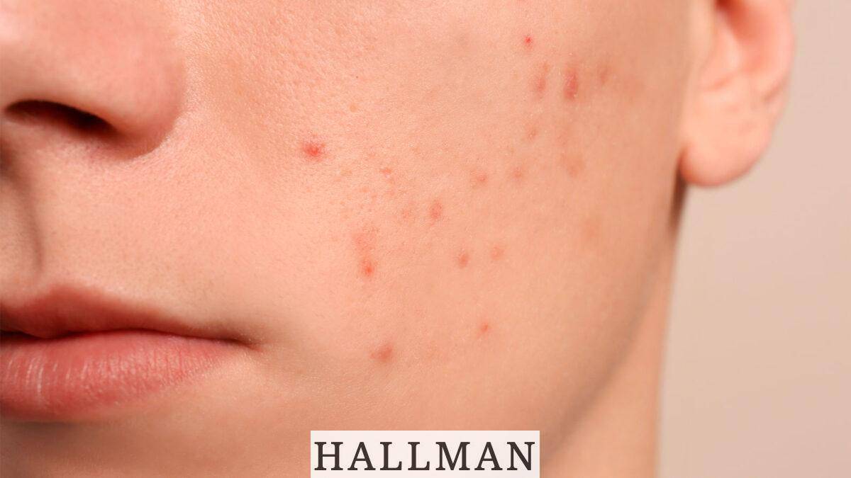 problemas-de-acne