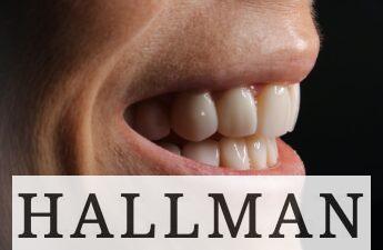 Carillas dentales en Valencia: precios, duración y resultados