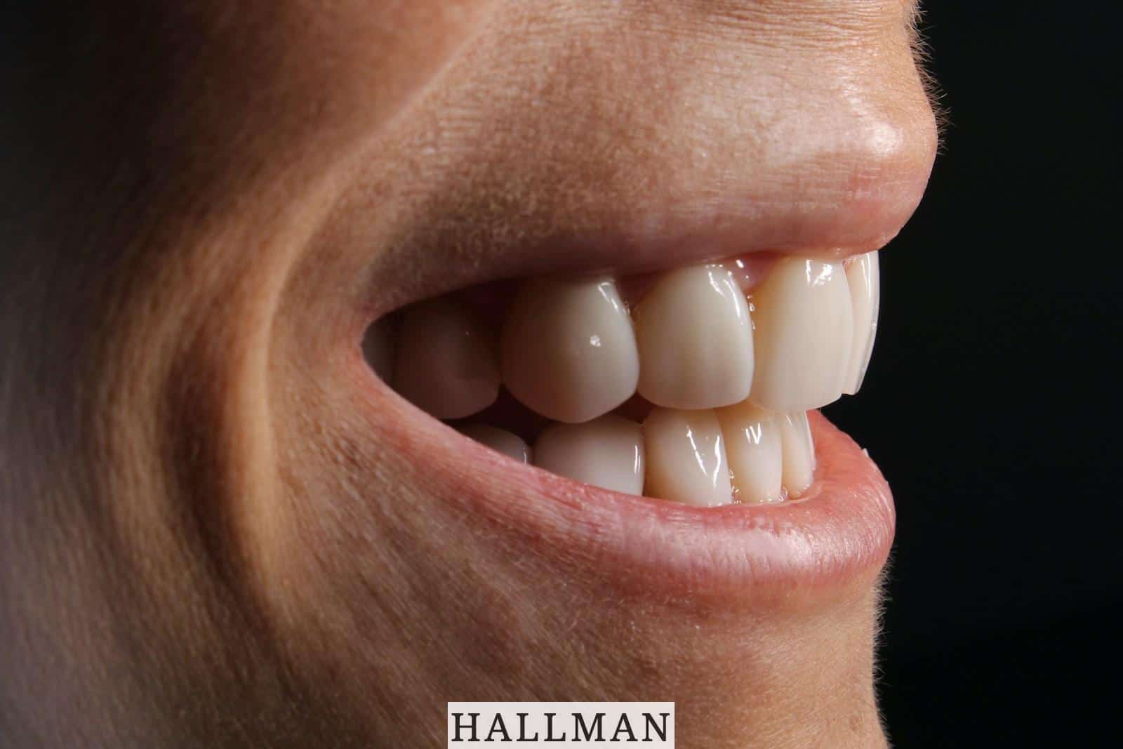 Carillas dentales en Valencia: precios, duración y resultados